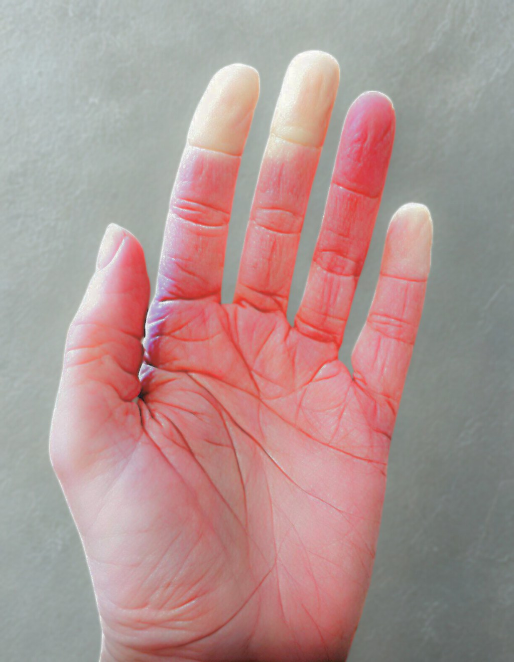 Understanding and Managing Raynaud’s&nbsp;Phenomenon
